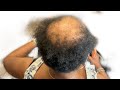 She shaved all her hair off but it didn’t grow back | Alopecia hair transformation