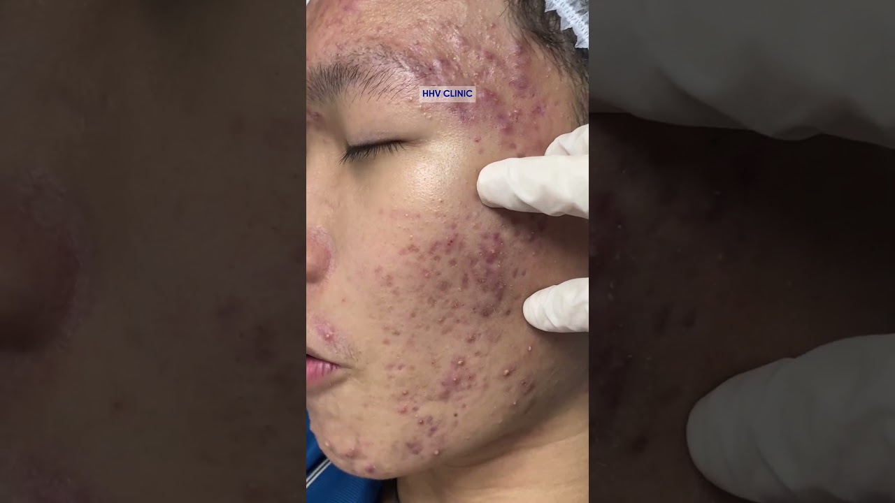 Mụn viêm thâm, điều trị không phương pháp để lại di chứng nặng.