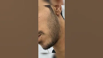 Shorts نتيجة استخدام المنكسديل للحية ١ 
