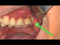 Third Molar Extraction | Pulling Out The Wisdom Tooth | Dentist | Dokter Gigi Tri Putra