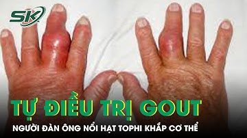Tự điều trị gout suốt 20 năm, người đàn ông nổi hạt tophi khắp cơ thể | SKĐS