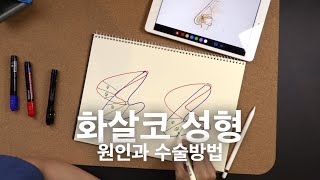 화살코 교정 | 해부학적인 구조를 손상시키지 않는 것이 핵심! | 구조를 지키면서 미용적인 부분까지 생각 해야 하는 어려운 수술💥 | 첫단추가 해냅니다!