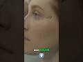 Hair Transplant Cost: Unlocking Your Perfect Look #shorts