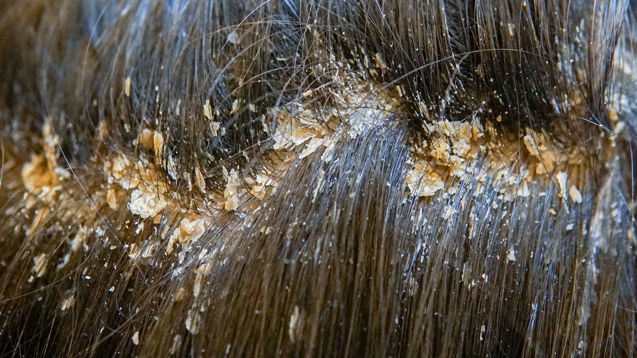 How To Remove Dandruff At Home with Easy Method (Huge Flakes) YouTube