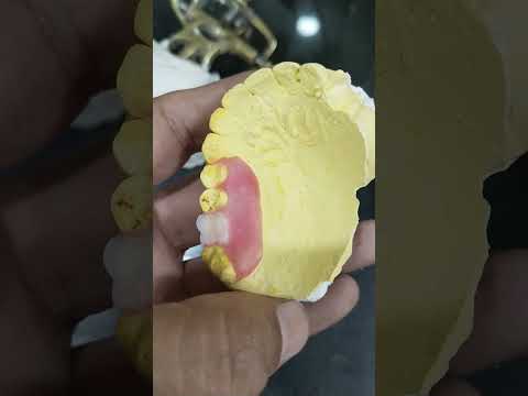 Single Unit Flexible Partial Denture Ready For Flasking 😁😁😁