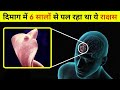 दिमाग में 6 सालों से पल रहा था ये राक्षस | Monster developed inside human brain till 6 year