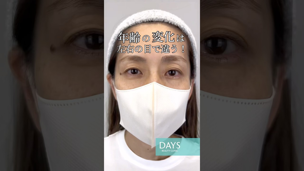Double eyelid surgery] What happens to the left and right eyes