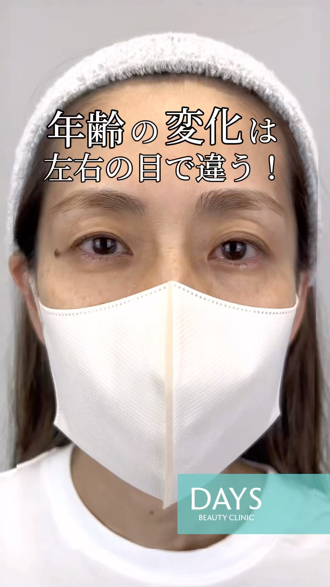 Double eyelid surgery] What happens to the left and right eyes