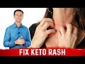 Keto Rash is a Vitamin B2 (Riboflavin) Deficiency
