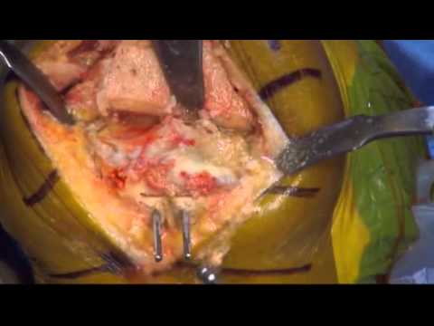 VISIONAIRE* Knee Surgical Video From NAHKS