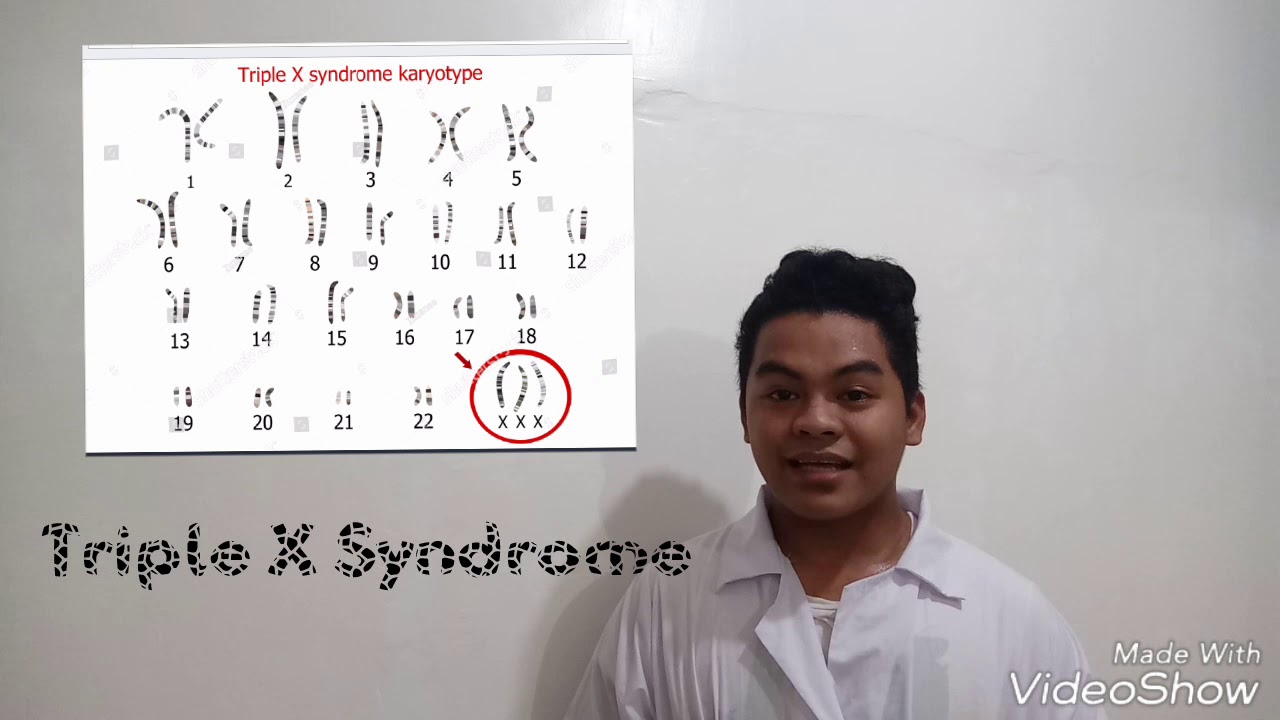 Triple X Syndrome Trisomy X Youtube