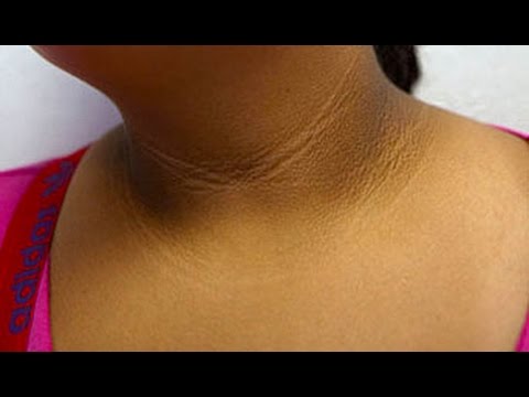 UNTV Life: Doctors On TV - Acanthosis Nigricans (skin ...