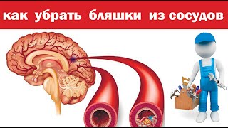 Рецепт от сужения сосудов головного мозга. Как убрать бляшки.