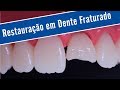 Restauração em Dente Fraturado