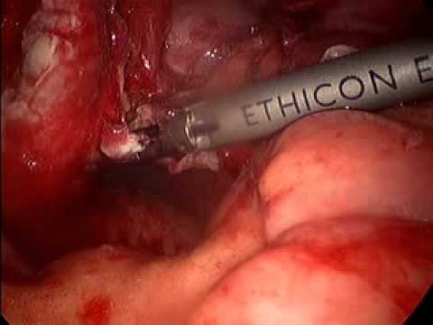 Laparoscopic Appendectomy, appendiceal rupture/peritonitis 4/4 - YouTube