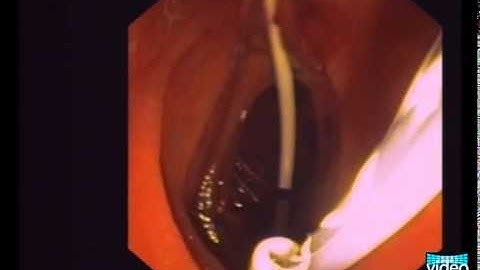 Over-the-Wire Stent Exchange Using a Simple Snare Technique in ERCP