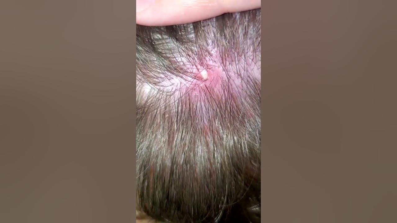 Big back cyst removal. YouTube