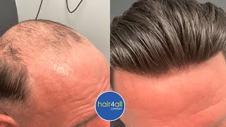 It's So Real! Undetectable Hair System Hair Line! Non-Surgical Hair Replacement System Men/Women UK