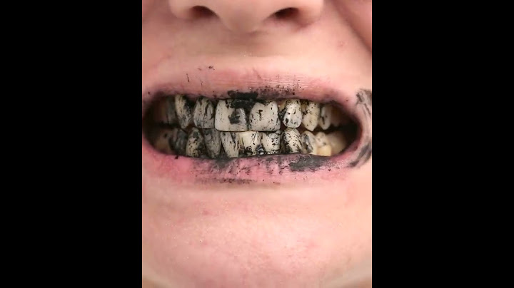 Hello Smile - Aktivni ugalj korišćenje