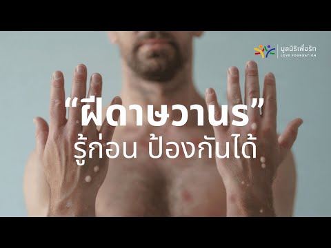 Love Foudation : ฝีดาษวานร รู้ก่อน ป้องกันได้