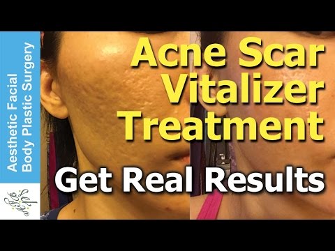 Treat All Types of Acne Scars in One Treatment in  Hours with the New Acne Scar Vitalizer Treatment