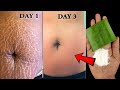 How To Get Rid Of Stretch Marks At Home With Aloe Vera Gel - Stretch Marks Treatment Naturally