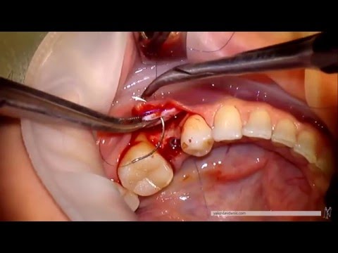 Video: Može li se implantacija kasniti?