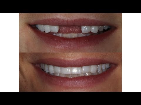 missing-teeth-|-implant-crowns-|-before-and-after-|-case-2