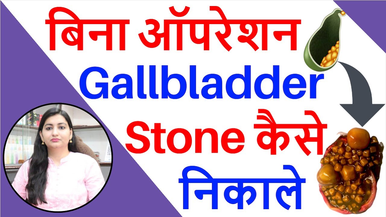 Gallbladder Stone का बिना ऑपरेशन इलाज Homeopathic Medicine for