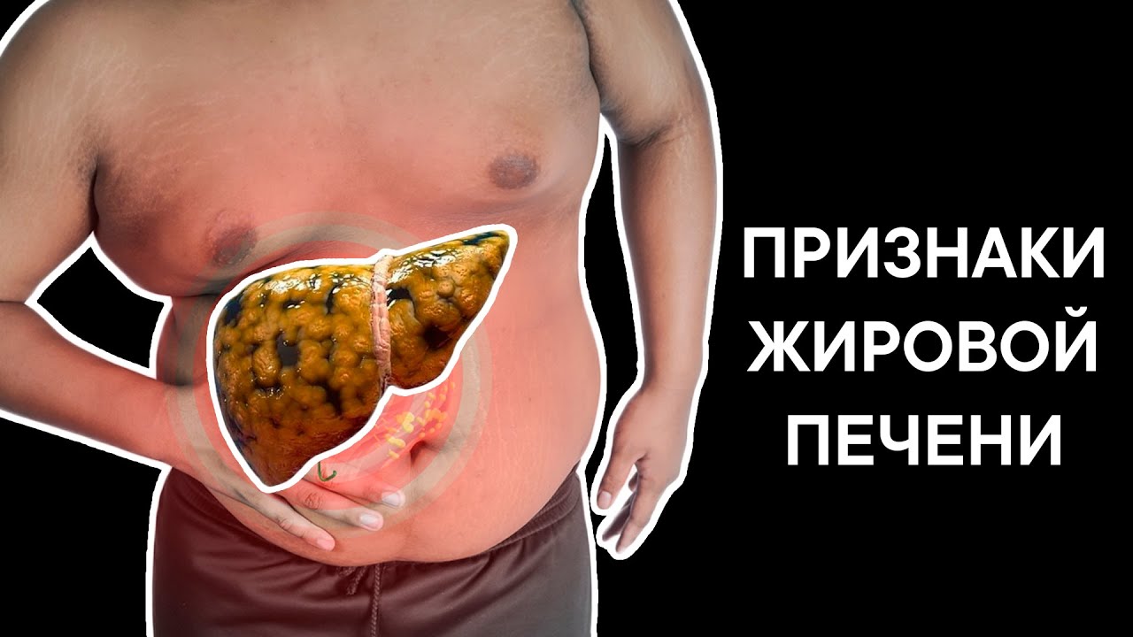 Жировая печень симптомы у мужчин. Жировой гепатоз печени.