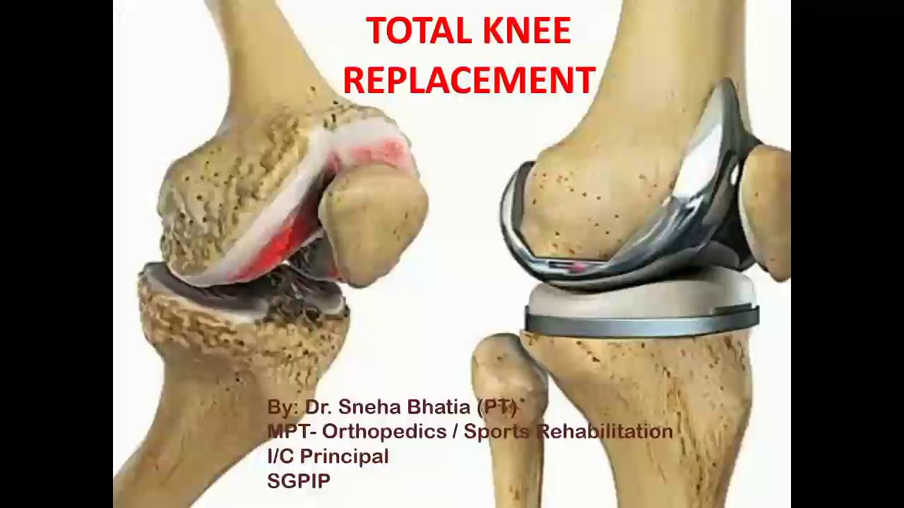 nursing case study total knee replacement