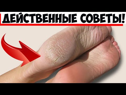 5 полезных советов для тех, кто страдает от шелушения кожи на пятках ног!