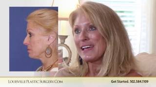 Face And Neck Lift - Carla - Age 63 - Post Operative Recovery