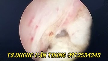Cắt U tuyến tiền liệt nội soi-Ông Hiêp- TS.BS.DUONG VĂN TRUNG 0913534343