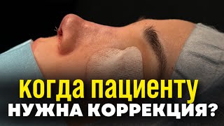 ПОВТОРНАЯ РИНОПЛАСТИКА / КОМУ МЫ ДЕЛАЕМ КОРРЕКЦИЮ?