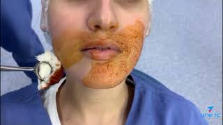Degermação do paciente - cirurgia oral Resimi
