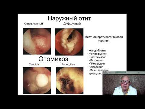 Лекция: Заболевания уха. ОНМедУ. Кафедра Оториноларингологии. Проф. Пухлик Сергей Михайлович.
