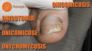 Onychomycosis  Fungus #podology #asmr