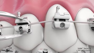 Mắc cài 3M Unitek Gemini SL Self Ligating System