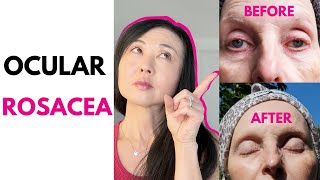 Ocular Rosacea Before and After