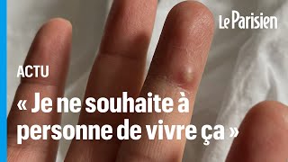 Variole du singe : « Je ne souhaite à personne de vivre ce que j'ai traversé »