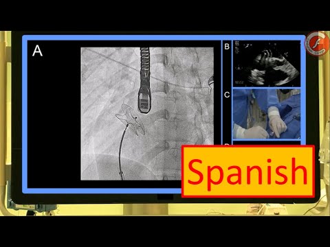 Video: Defecto Cardíaco Congénito (defecto Del Tabique Auricular) En Perros