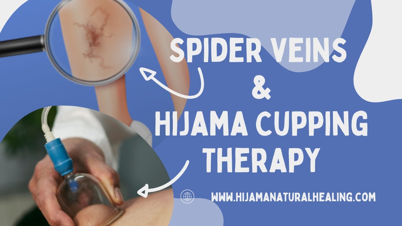 Spider Veins & Hijama Cupping Therapy | Natural Treatment Explained | Hijama Natural Healing