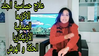 علاج رهيب لكل أنواع الحساسية الجلدية الاكزيما/الصدفية/الحكة/حساسية الأرتيكاريا