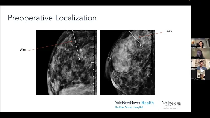 Smilow Shares: Advances in Breast Cancer