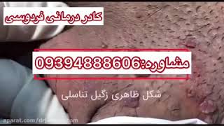 شکل ظاهری زگیل_تناسلی