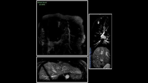 Whole Heart CE MRA - Gadovist @ Siemens 1.5T AvantoFit