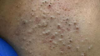 The Ultimate Facial Deep Cleanse — Blackhead and Pimple Removal