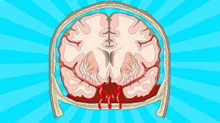 Stroke: subarachnoid haemorrhage by The Learn Medicine Show 9,299 views 5 months ago 6 minutes, 47 seconds