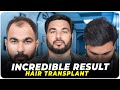 Hair transplant in kota  best results  cost of hair transplant in kota